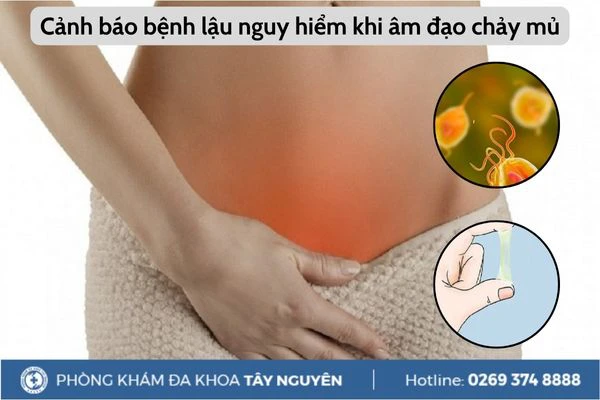 Cảnh báo bệnh lậu nguy hiểm khi âm đạo chảy mủ