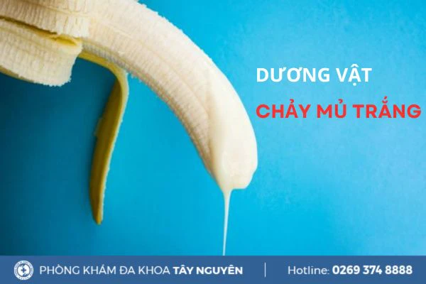 Dương vật chảy mủ trắng nguy cơ cao mắc bệnh lậu?